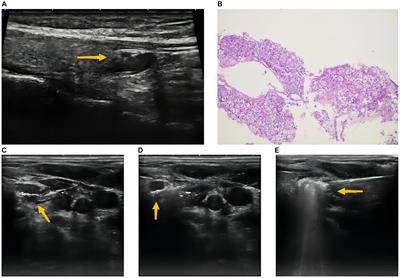 Case report: Microwave ablation is a safe and effective method for primary hyperparathyroidism in pregnancy